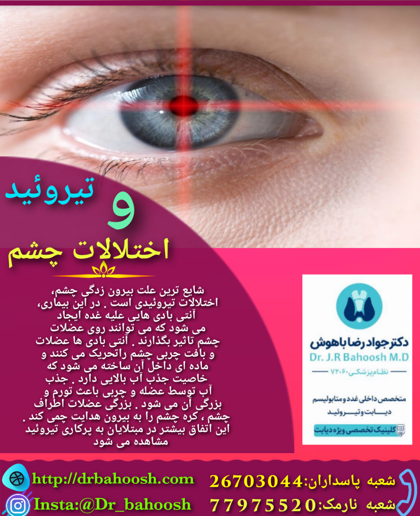 بیماری تیروئید چشمی اختلالی است که باعث التهاب عضلات چشم و بافت چربی پشت چشم می‌شود. در این اختلال، چشم‌ها برآمده شده و از حدقه بیرون می‌زنند و معمولاً چشم‌ها و پلک‌ها متورم و قرمز می‌شوند.
