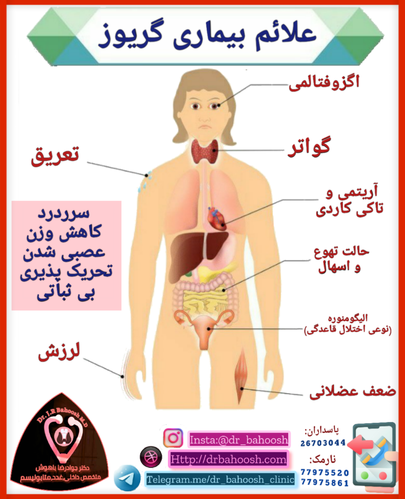 بیماری گریوز یک بیماری خود ایمنی است که موجب پرکاری تیروئید می‌شود. در این بیماری، سیستم ایمنی به غده‌ی تیروئید حمله کرده و وادارش می‌کند بیش از نیاز بدن، هورمون تیروئید تولید کند.