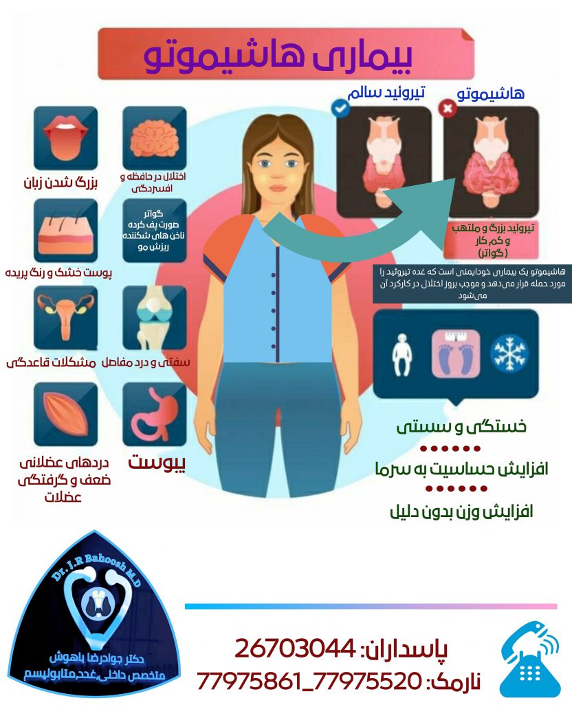 در بیماری هاشیموتو ( تیروئیدیت لنفوسیتی مزمن)، سیستم ایمنی بدن به غده تیروئید حمله می‌کند. گاهی این التهاب منجر به کاهش فعالیت غده تیروئید (هیپوتیروئیدیسم) می‌گردد.