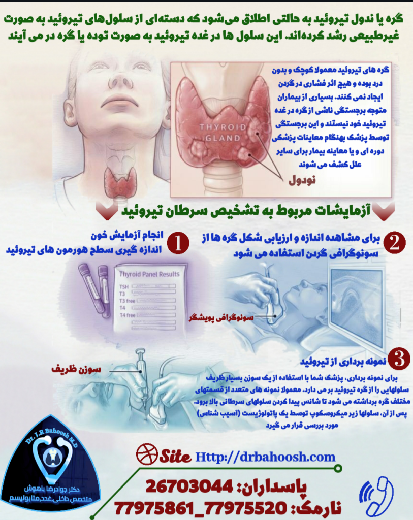 گره یا ندول تیروئید به حالتی اطلاق می‌شود که دسته‌ای از سلول‌های تیروئید به صورت غیرطبیعی رشد کرده‌اند. این سلول ها در غده تیروئید به صورت توده یا گره در می آیند. با وجود اینکه بیشتر گره‌های تیروئید خوش خیم هستند تعداد کمی از آنها نیز ممکن است دارای سلولهای سرطانی باشند. به همین علت بررسی گره های تیروئید به منظور تشخیص این بدخیمی ها انجام می شود.